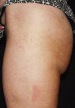 Body Profile after application