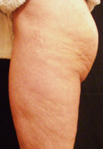 Body Profile before application