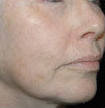 Cosmetic Roll CIT after application