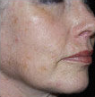 Cosmetic Roll CIT before application